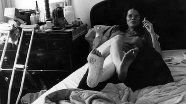 Black and white photo of a woman with a cast on the left leg with right bare leg crossed over it. The person lies on a bed with back propped up with pillow, holding a cigarette.