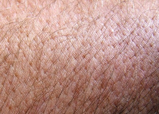 how to treat ringworm on skin